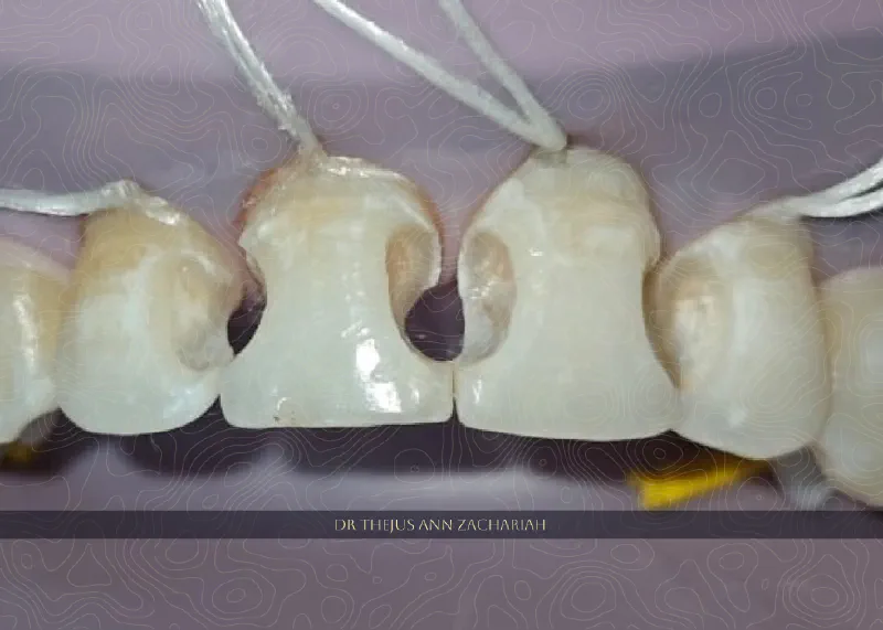 Composite Restoration