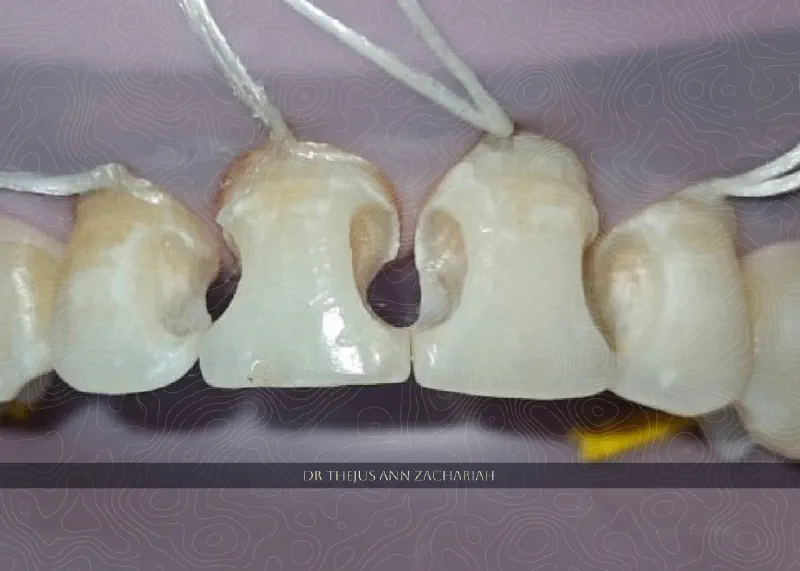 Composite Restoration