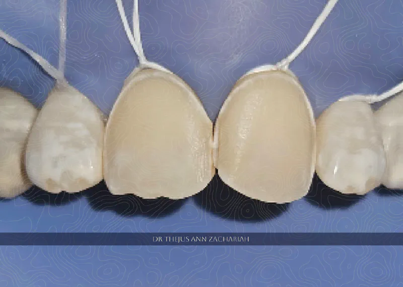 Direct Composite Veneer