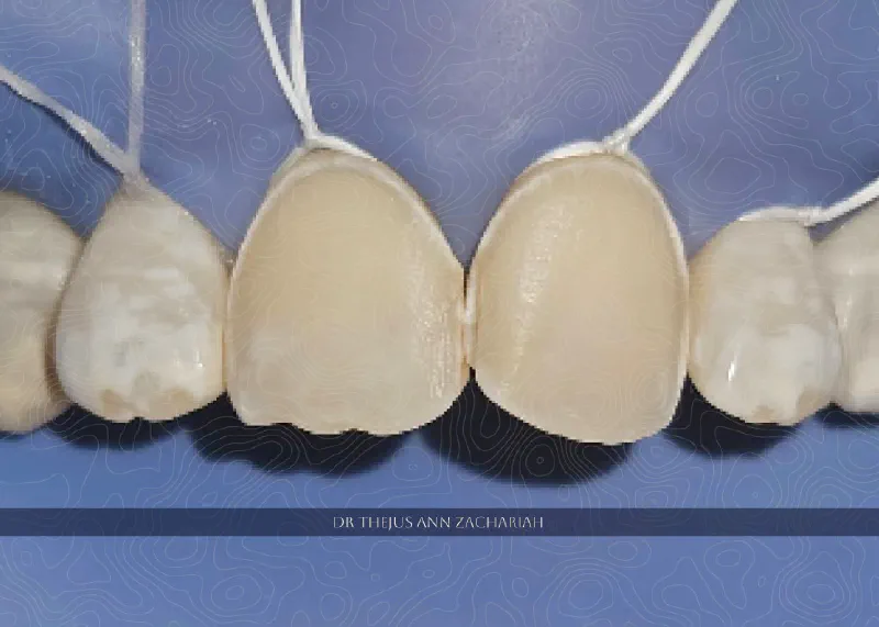 Direct Composite Veneer