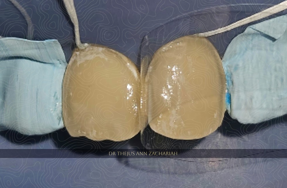 Bonding Agent Application