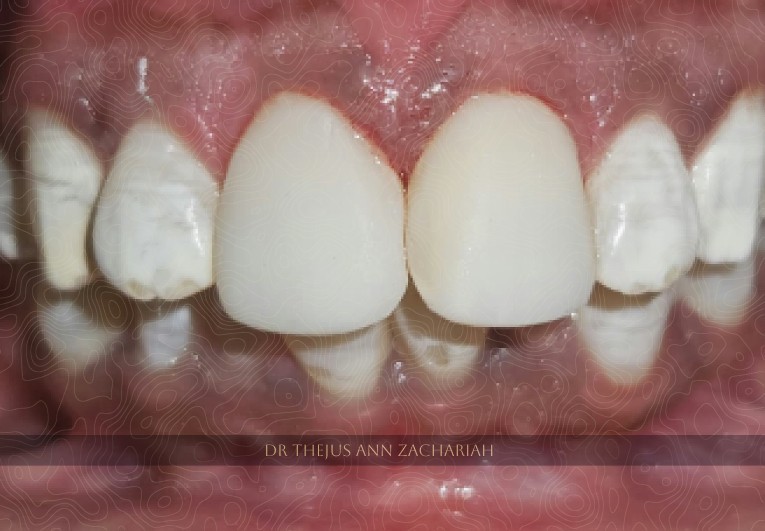 Veneer Post Polishing