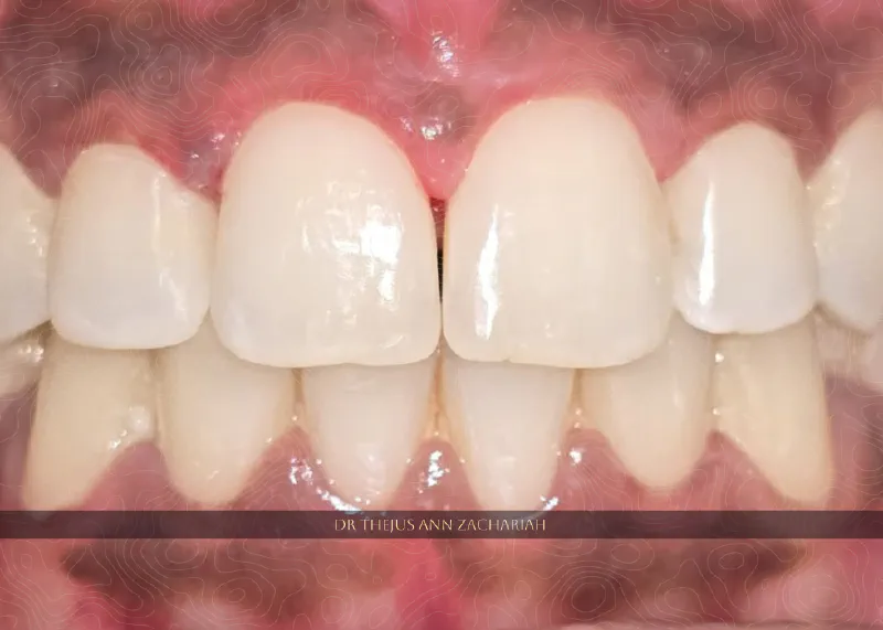 Diastema Closure