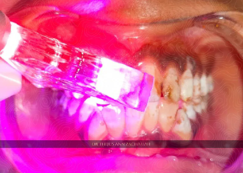 Laser Assisted Vital Bleaching