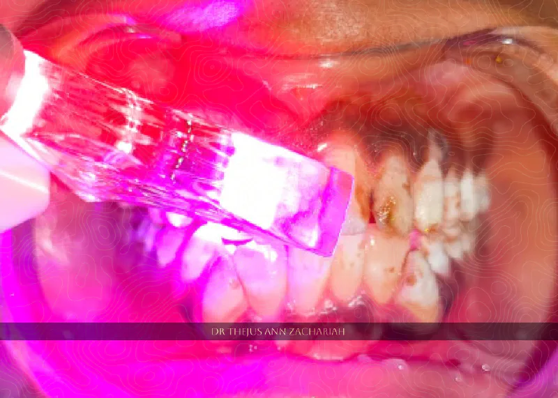 Laser Assisted Vital Bleaching