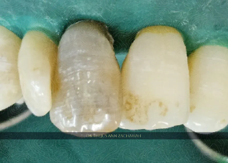 Non Vital Intracoronal Bleaching