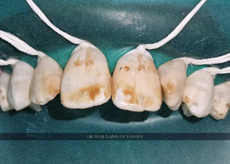 Vital Tooth Bleaching