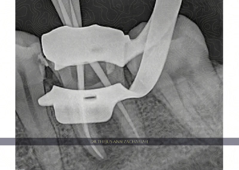 RCT - Through Crown 36