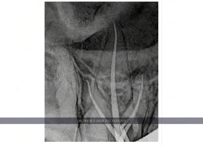 RCT - Upper Molar With MB2 - 16